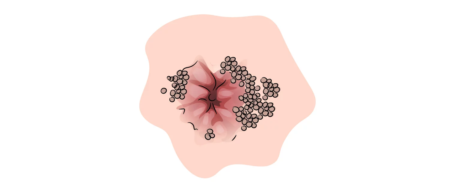 Genital Siğil 