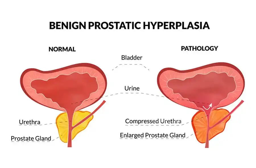 İyi Huylu Prostat Büyümesi (BPH)
